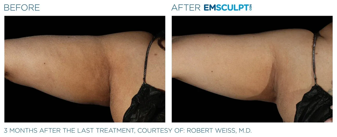 Female arms before and after Emsculpt Neo — courtesy of Robert Weiss, M.D.