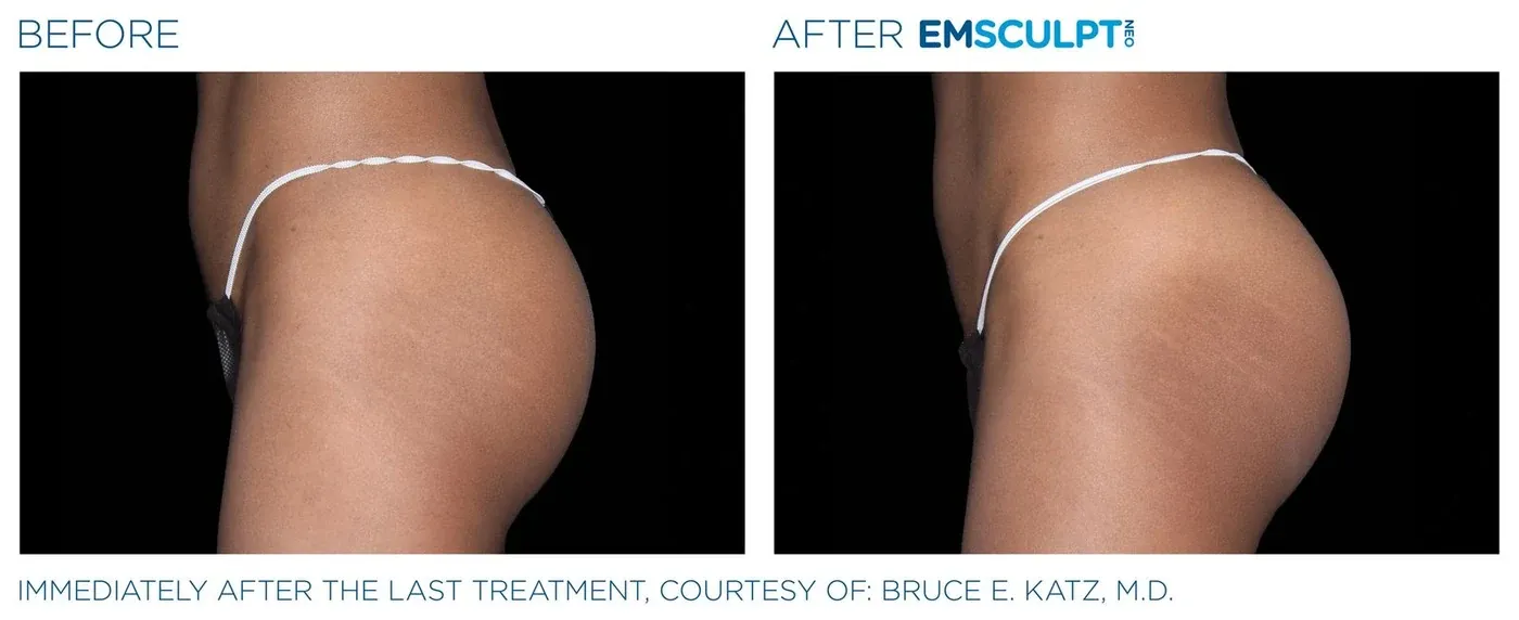 Female buttock before and after Emsculpt Neo — courtesy of Bruce E. Katz, M.D.