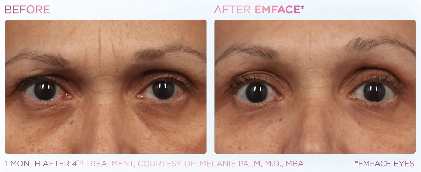 Female eye area before and after EMFACE