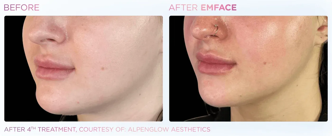 Female jawline before and after EMFACE