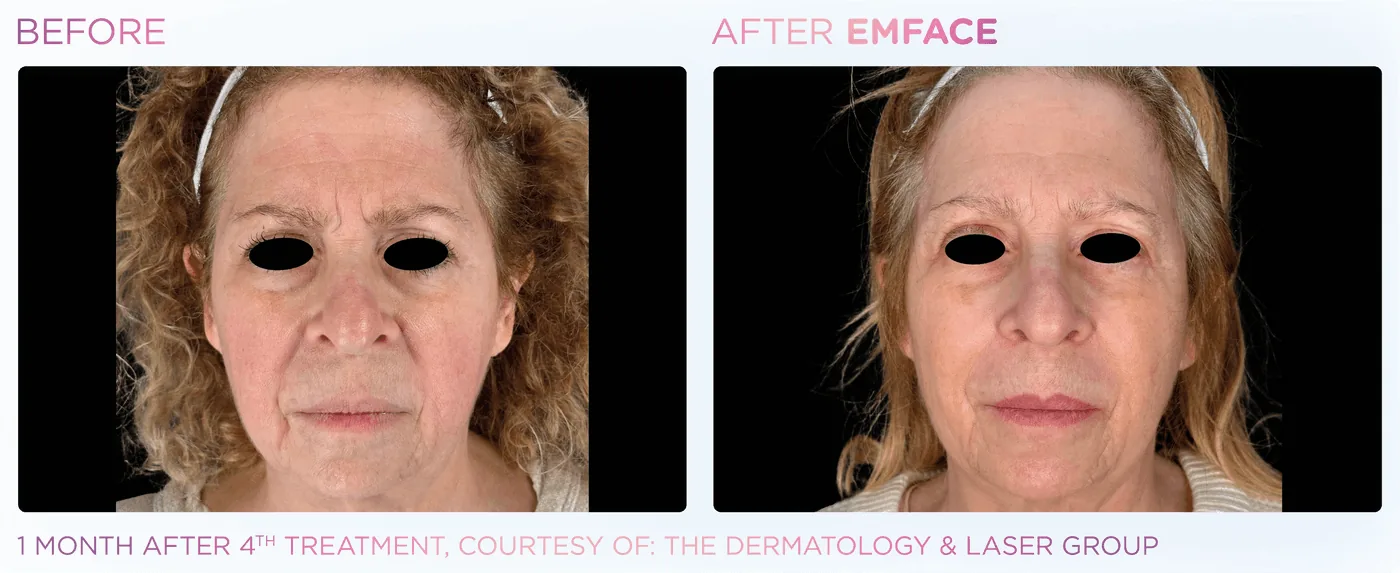 Rostro completo en una mujer, antes y después de EMFACE