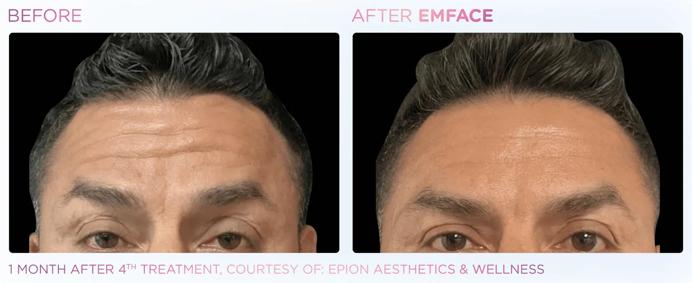 Frente en un hombre, antes y después de EMFACE