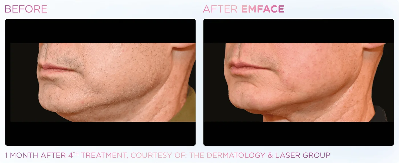 Línea mandibular en un hombre, antes y después de EMFACE