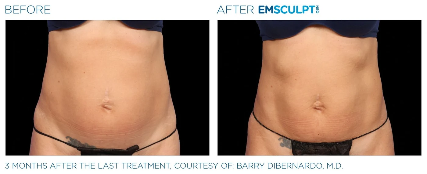 Abdomen femenino antes y después de Emsculpt Neo — cortesía de Barry DiBernardo, M.D.