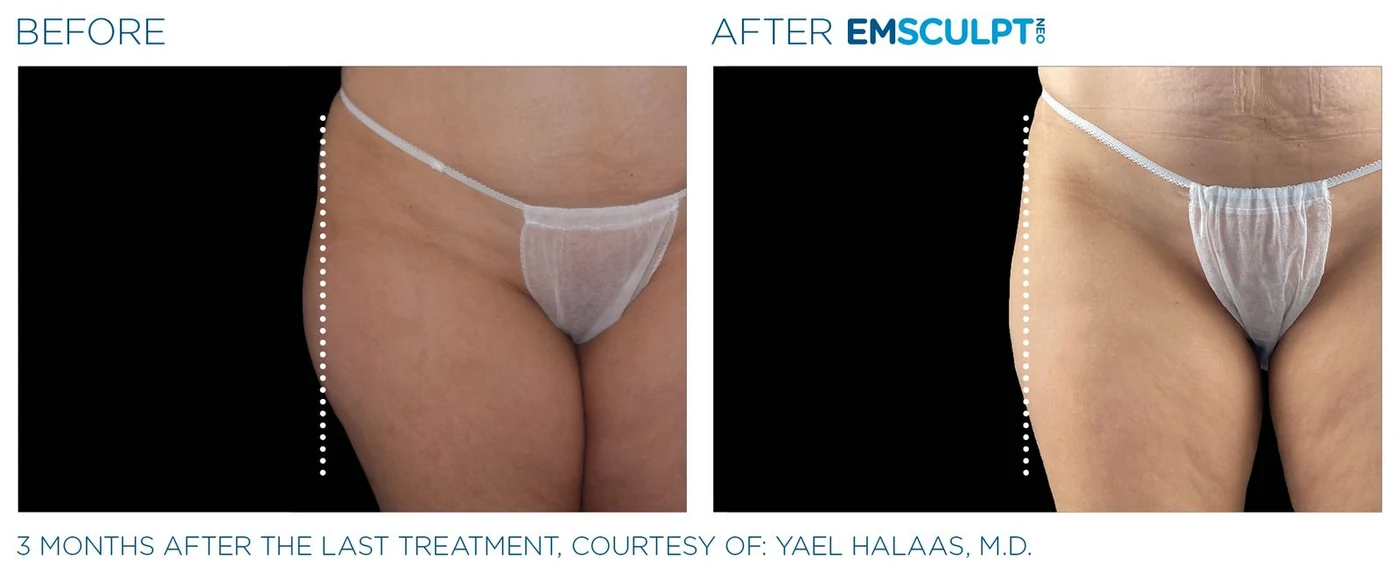 Muslos externos femeninos antes y después de Emsculpt Neo