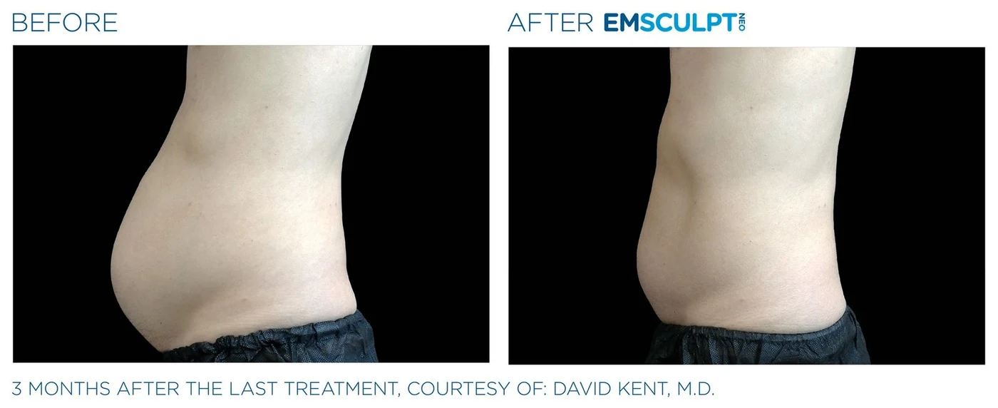 Abdomen masculino antes y después de Emsculpt Neo — cortesía de David Kent, M.D.