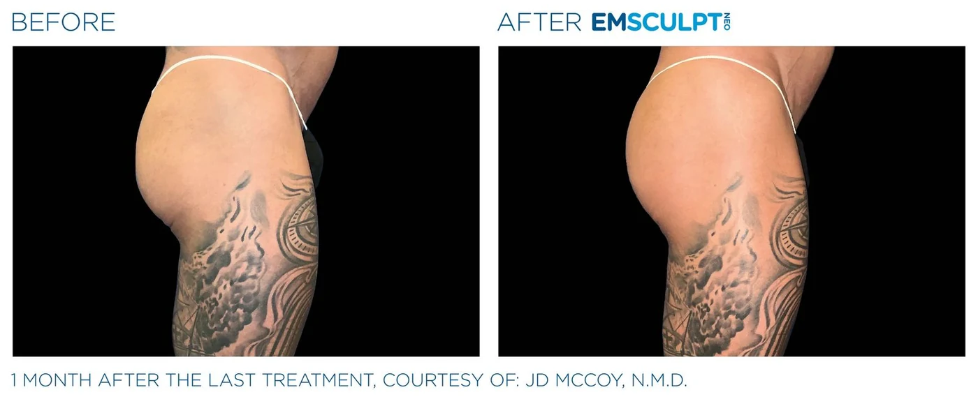 Glúteos masculinos antes y después de Emsculpt Neo — cortesía de JD McCoy, N.M.D.